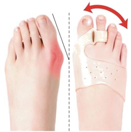 Magnetic Toe Corrector