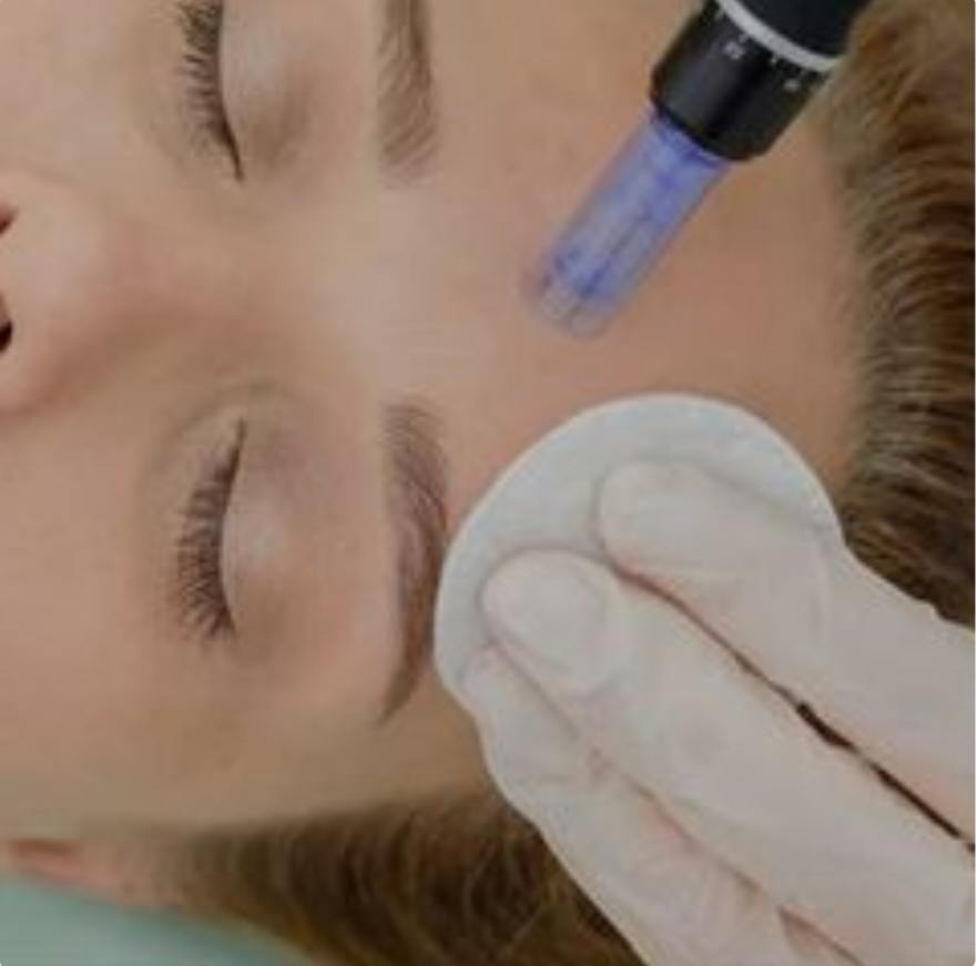 Collagen Induction Therapy