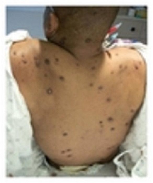 Waldenstrom’s Macroglobulinemia : An uncommon skin disease