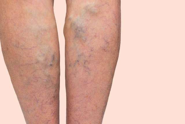 D-Dimer فحص تخثر الدم 