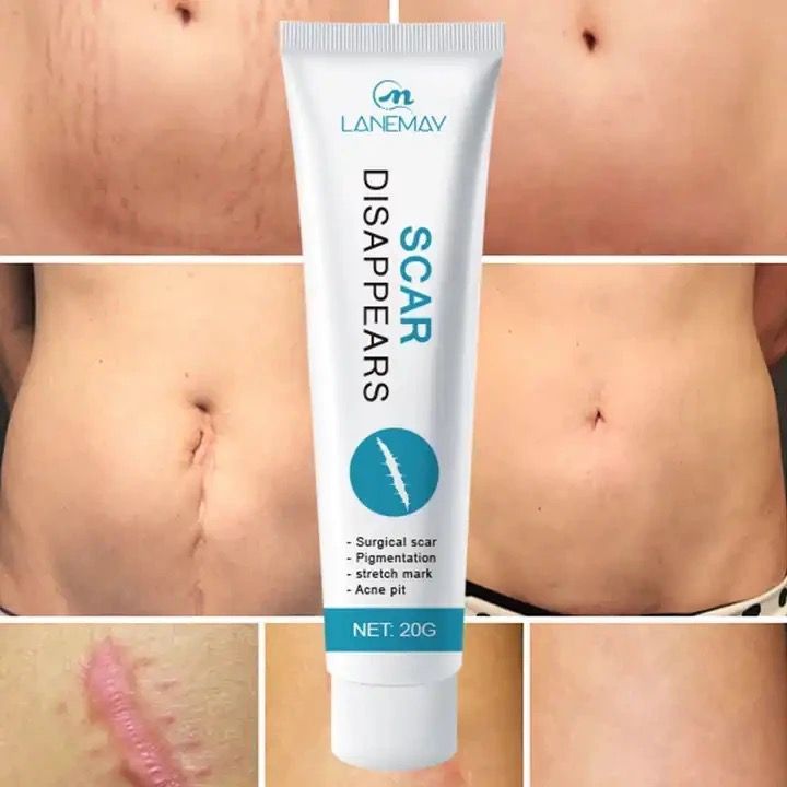 new arrival acne pimples stretch marks scar removal scar removal cream for old scars on face and legs body scar removal cream