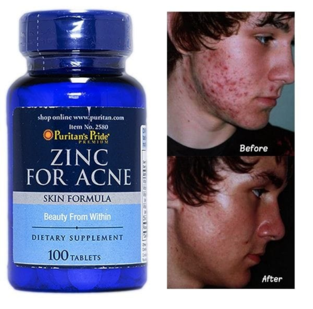 Zinc pour acné 