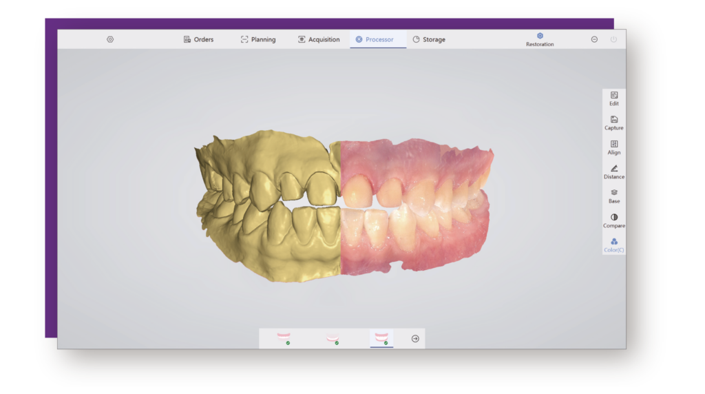 Escaneo Intraoral