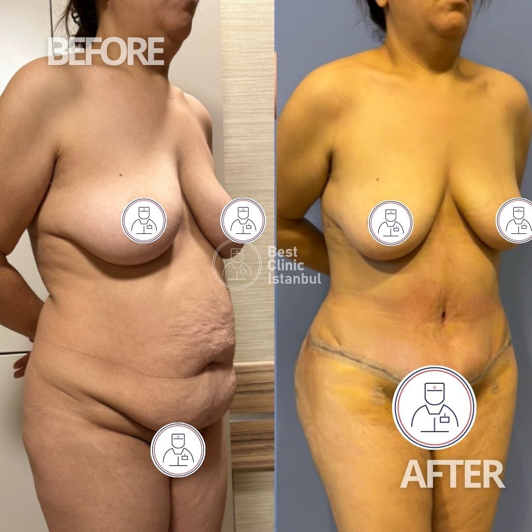 Liposuccion 360 + Abdominoplasty 