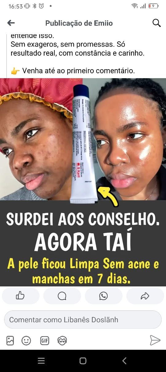 Pomada para o tratamento de acnes