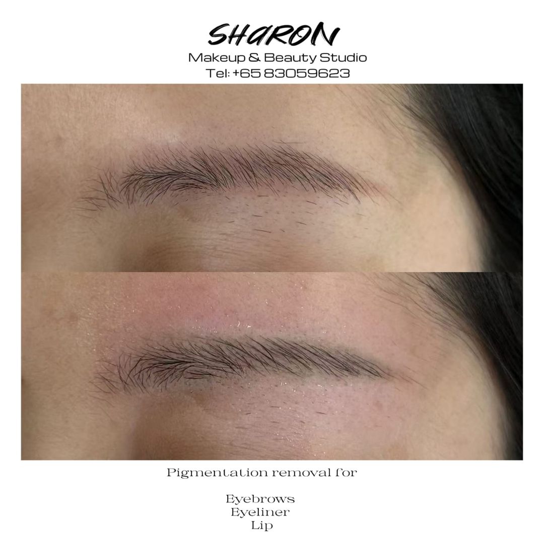 Pigmentation Removal (Deposit)