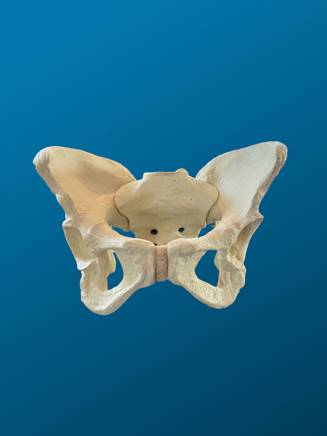 Pelvis Displasica