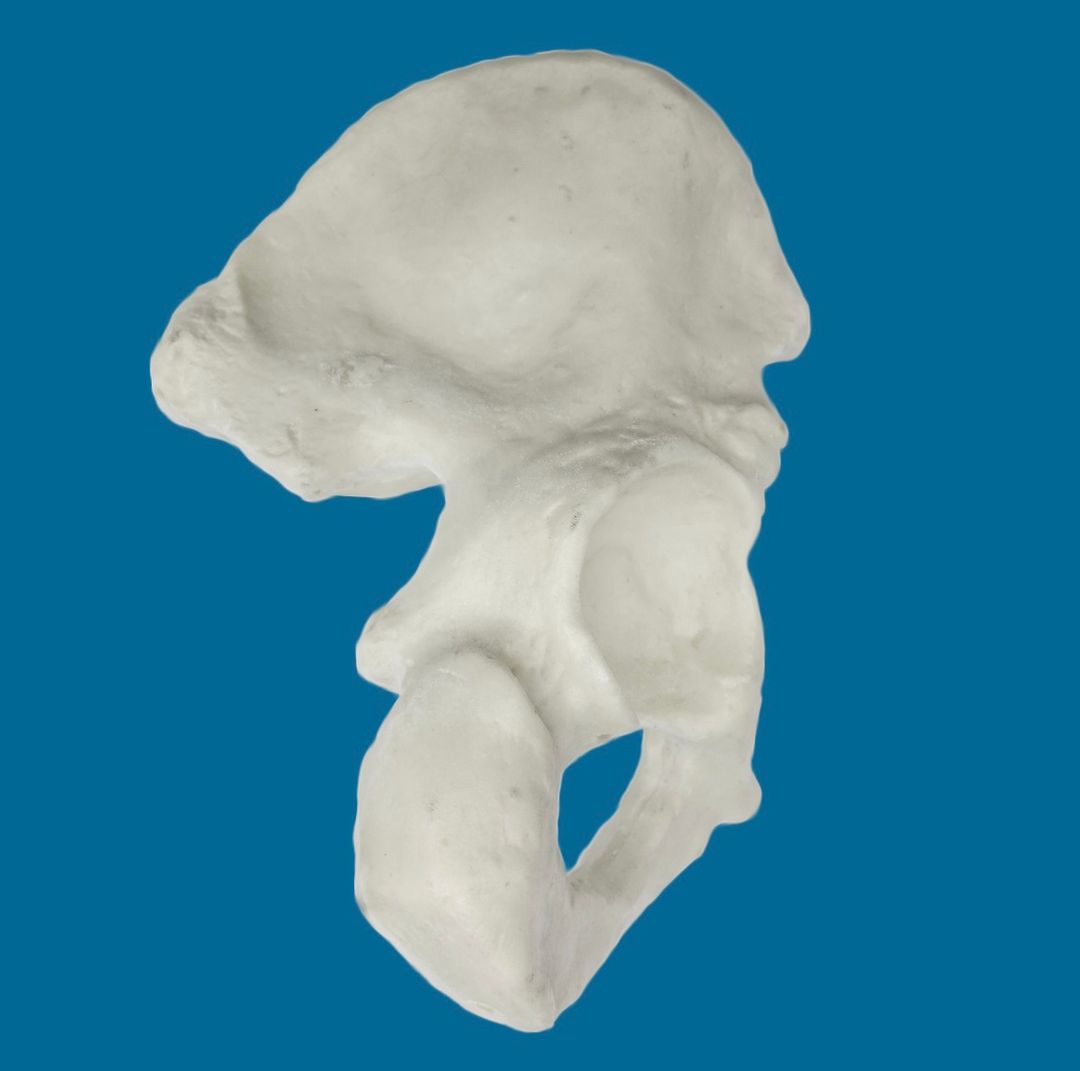 Hemipelvis con acetábulo de 57 mm, izquierdo