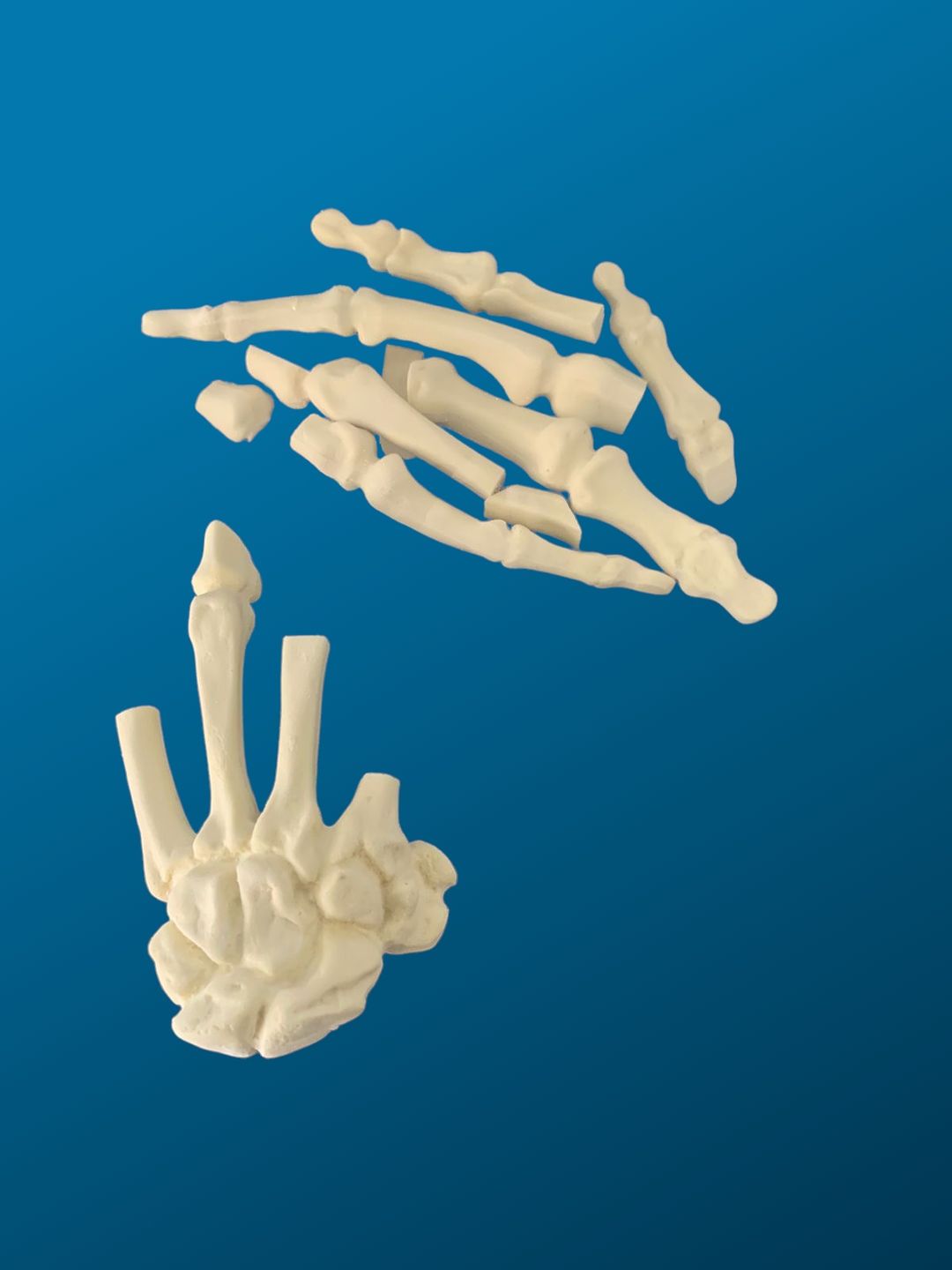 Mano con falanges fracturadas