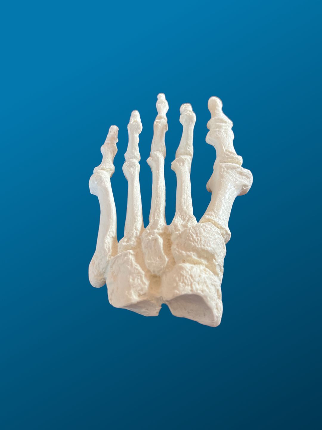 Antepie con dedos de martillo, juanetes y exostosis. Izquierdo.