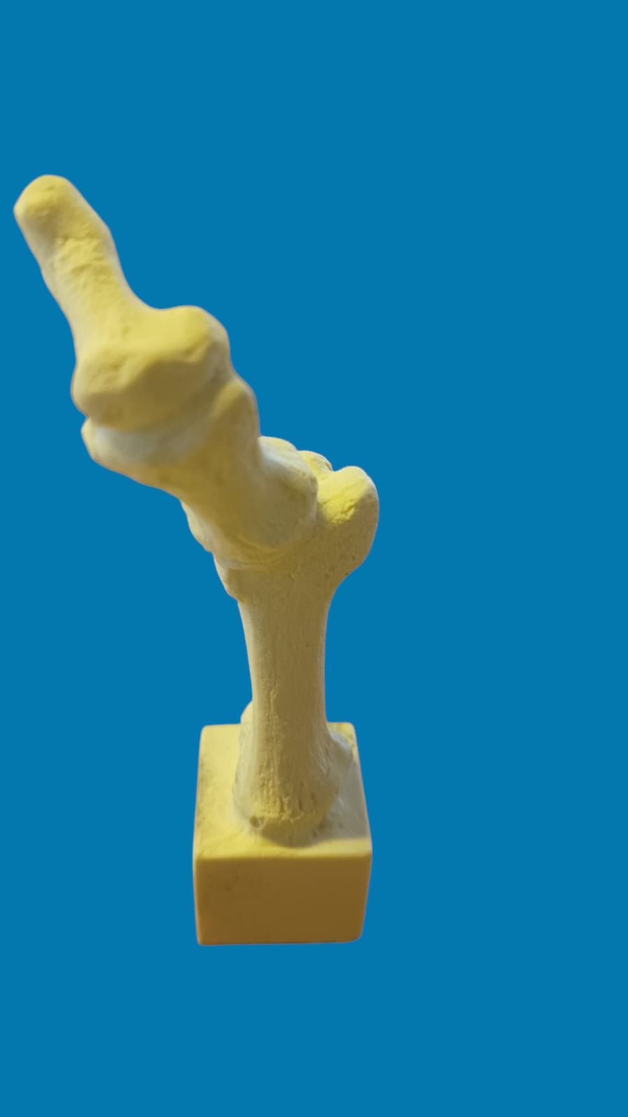 Metatarsiano con dedo de martillo
