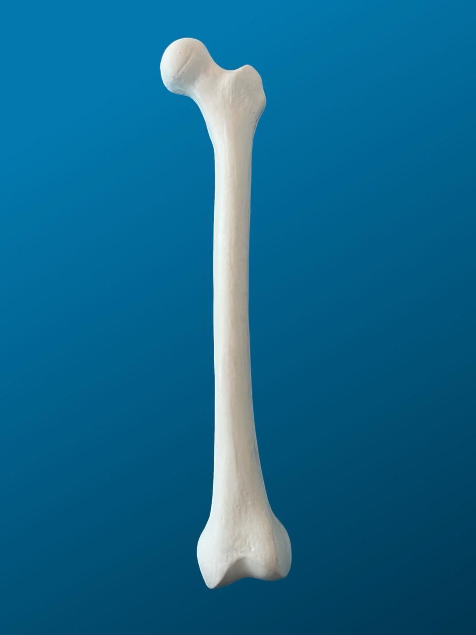 Fémur con deformidad en valgo distal de 10 grados, izquierdo
