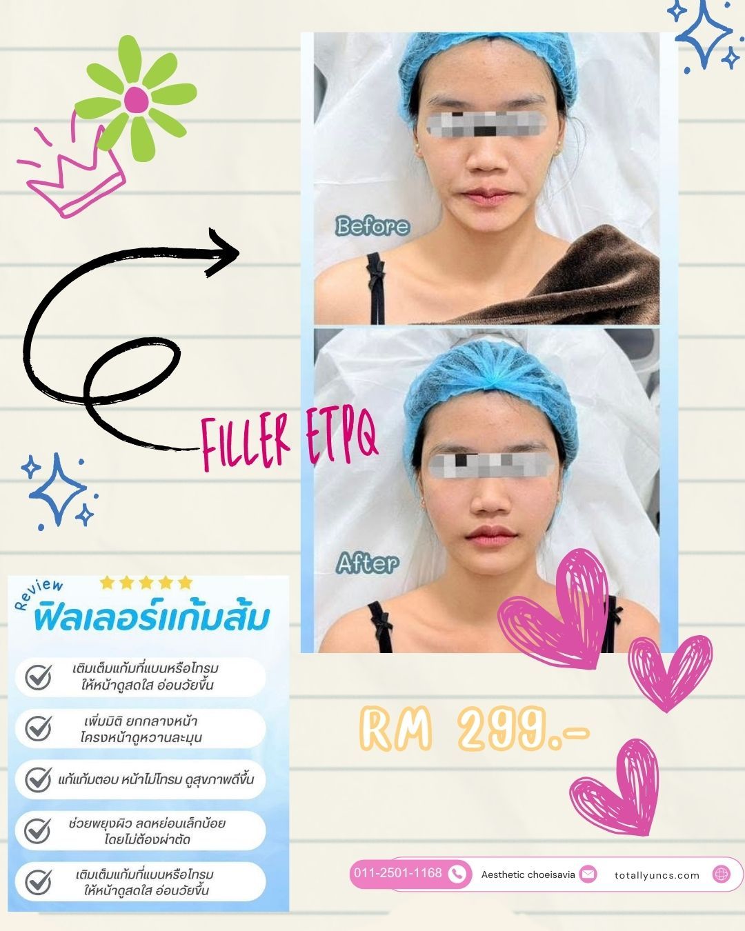 Review 🩷💉Filler แก้มส้ม ทำให้ดูเด็ก ละมุนอ่อนเยาว์👶🏻