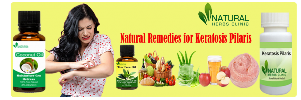 14 Natural Remedies for Keratosis Pilaris (Bumps on the Skin)_0