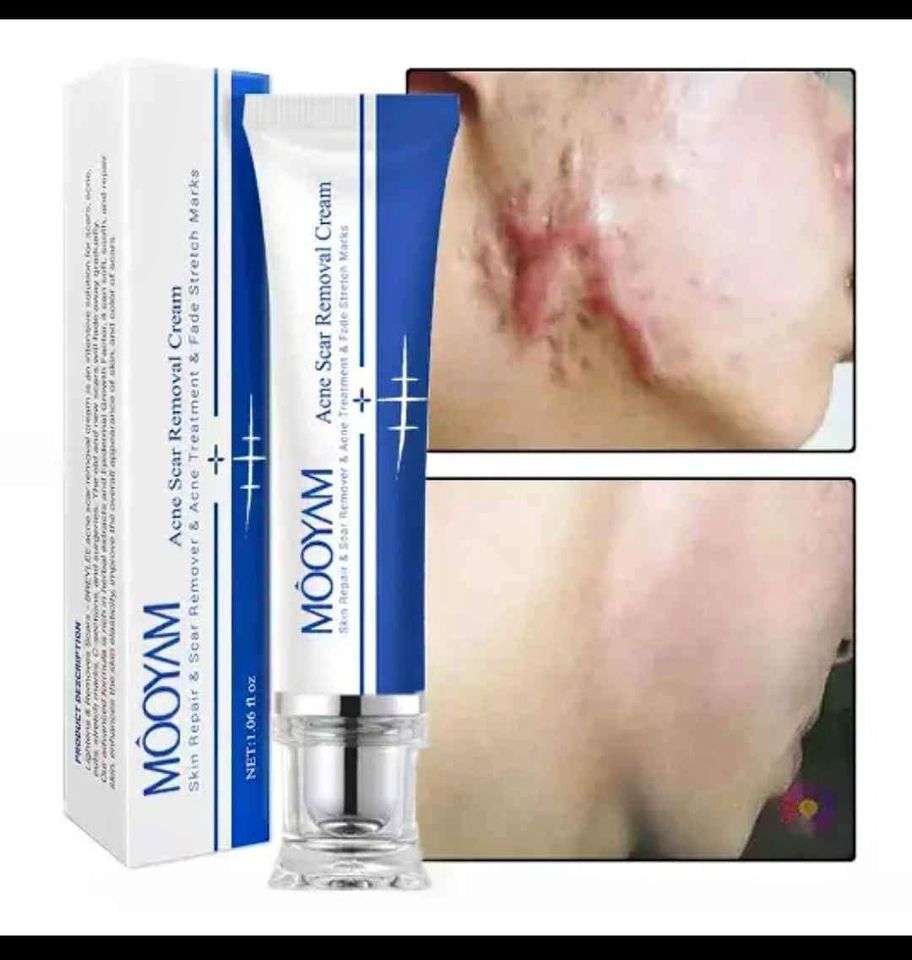 Scar Removal Cream_0