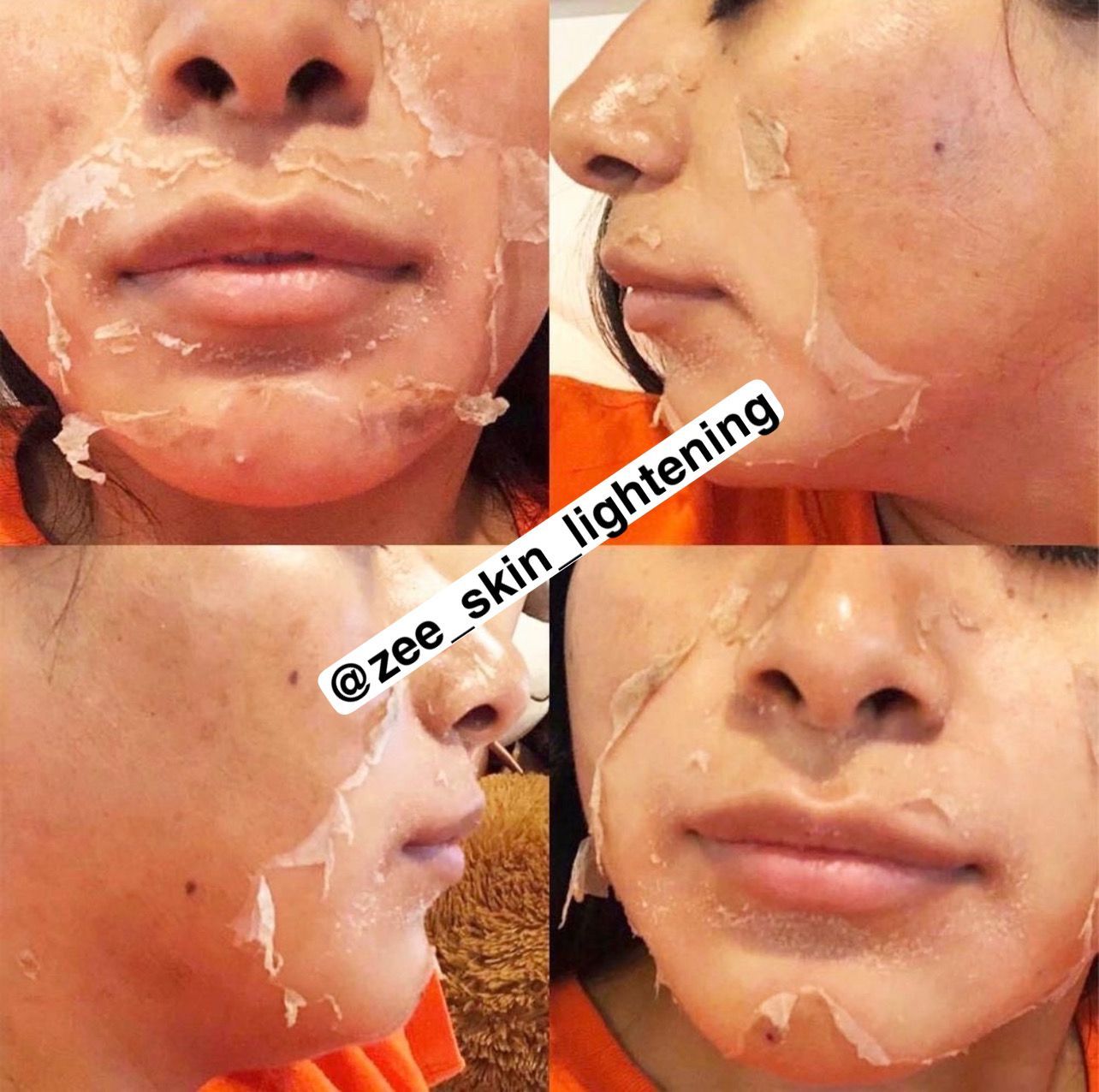 Chemical Peel _1