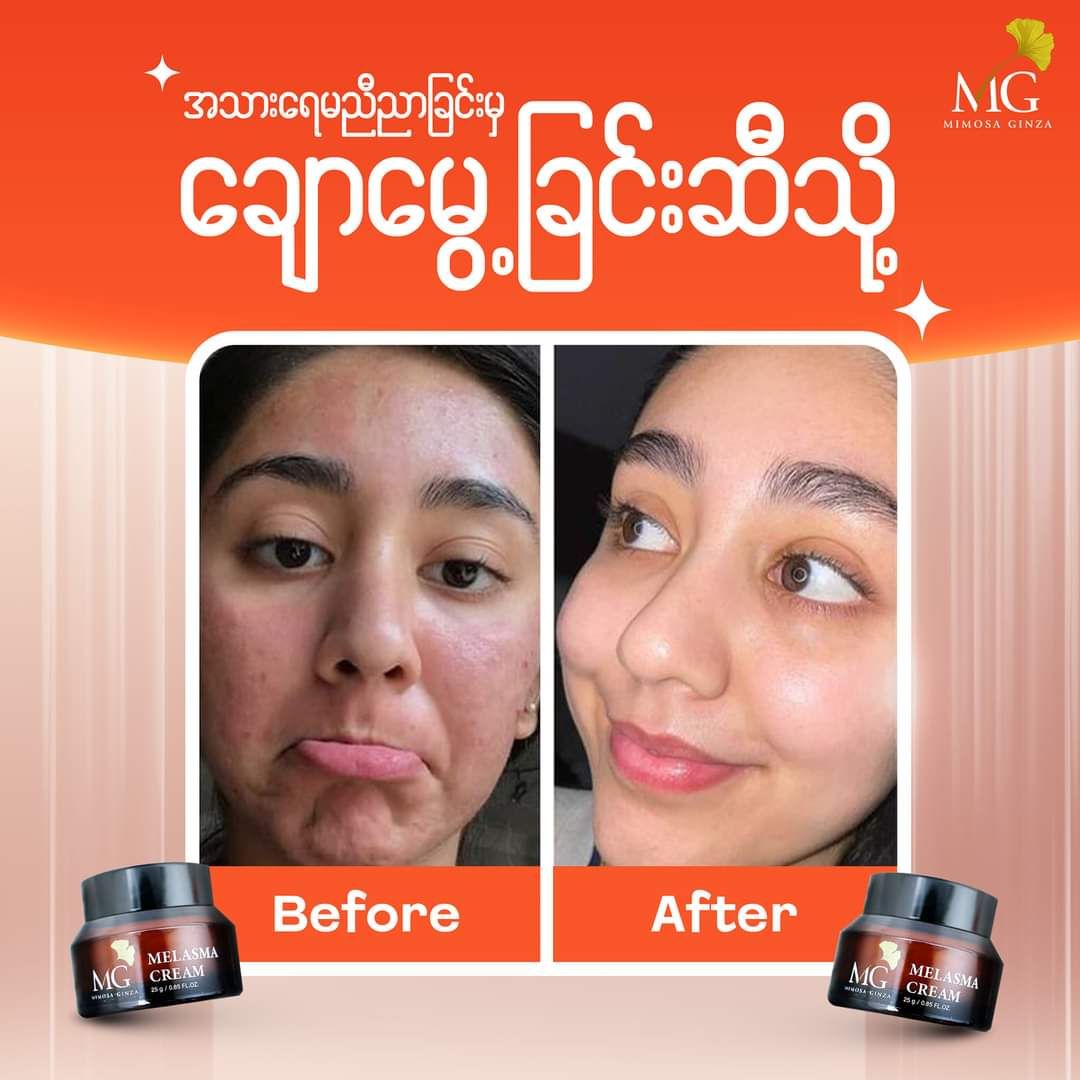 Mimosa Ginza_Melasma Cream (New)_4