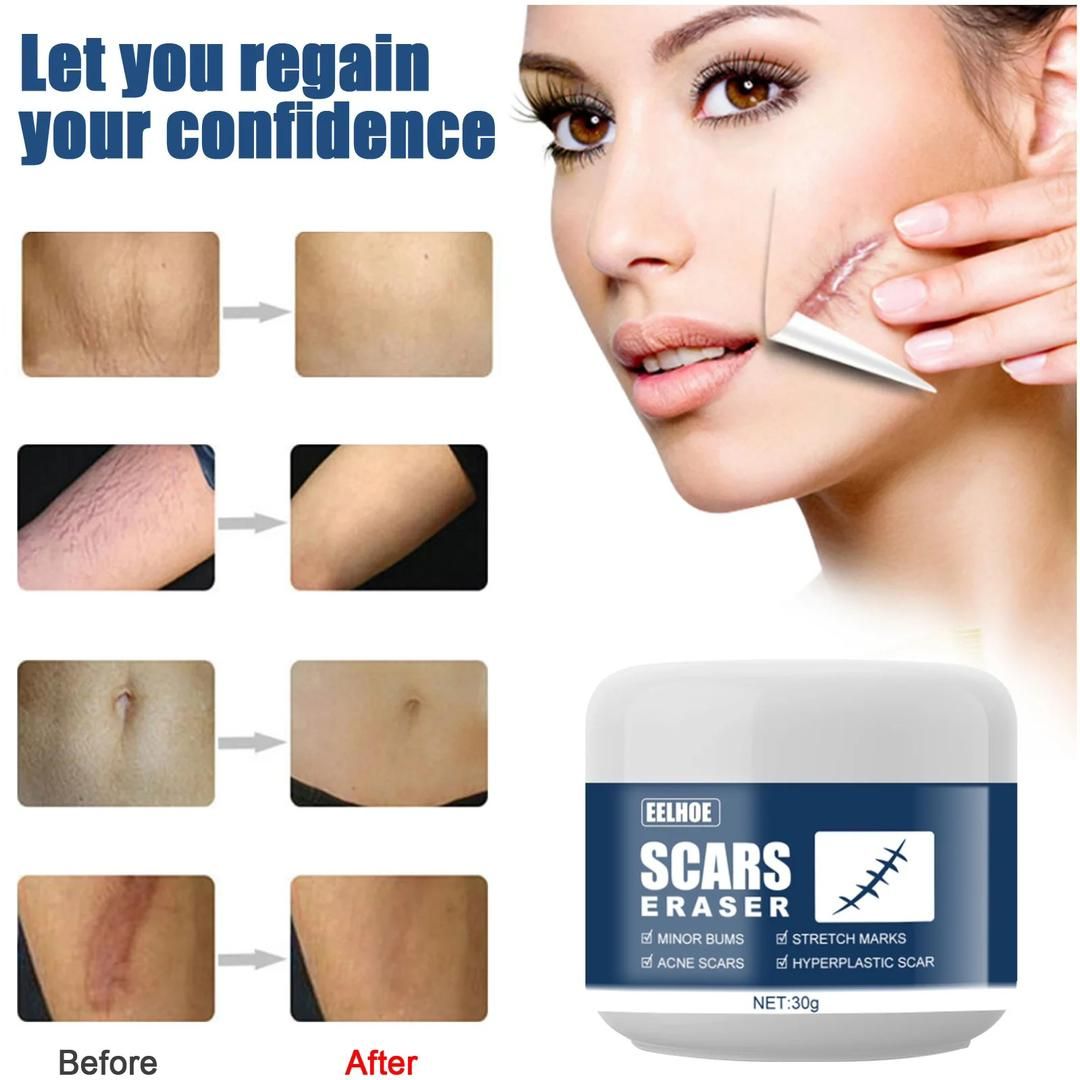 eelhoe skin repair cream lightening scar gel cream burns burns pox marks lightening smooth skin scar gel cream 30g _3