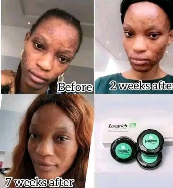 Savon noir au bambou naturel (Contre boutons, acnés, vergetures, phares,…100g×3)_6