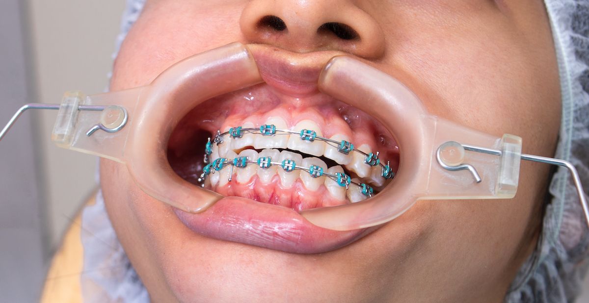 Braces (Orthodontie)_0