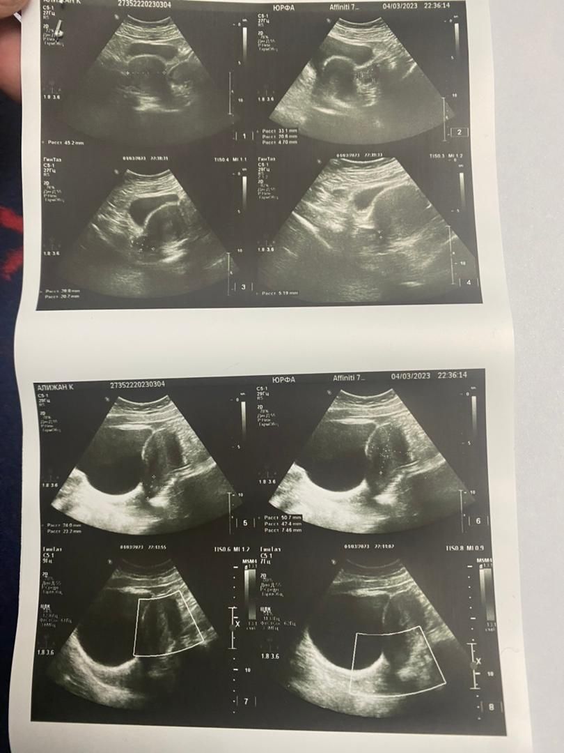 Kyrgyzstan Surrogacy & Egg Donor | Bishkek | 25 Yrs Old, Blood Type A, 160cm, 52kg | ID #120038 |_5
