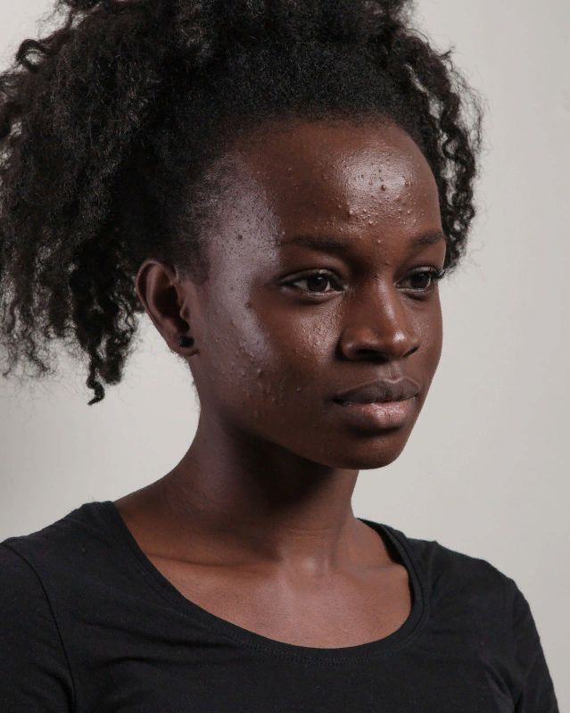 ROUTINE ACNÉ NON INFLAMMATOIRE 💊_0