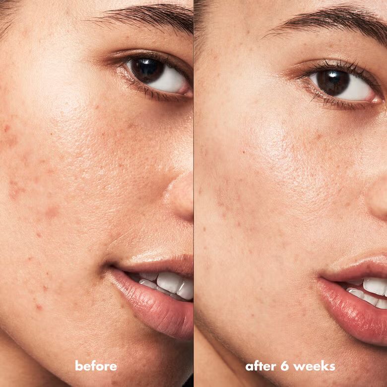 Blemish Breakthrough Acne Spot Gel_2