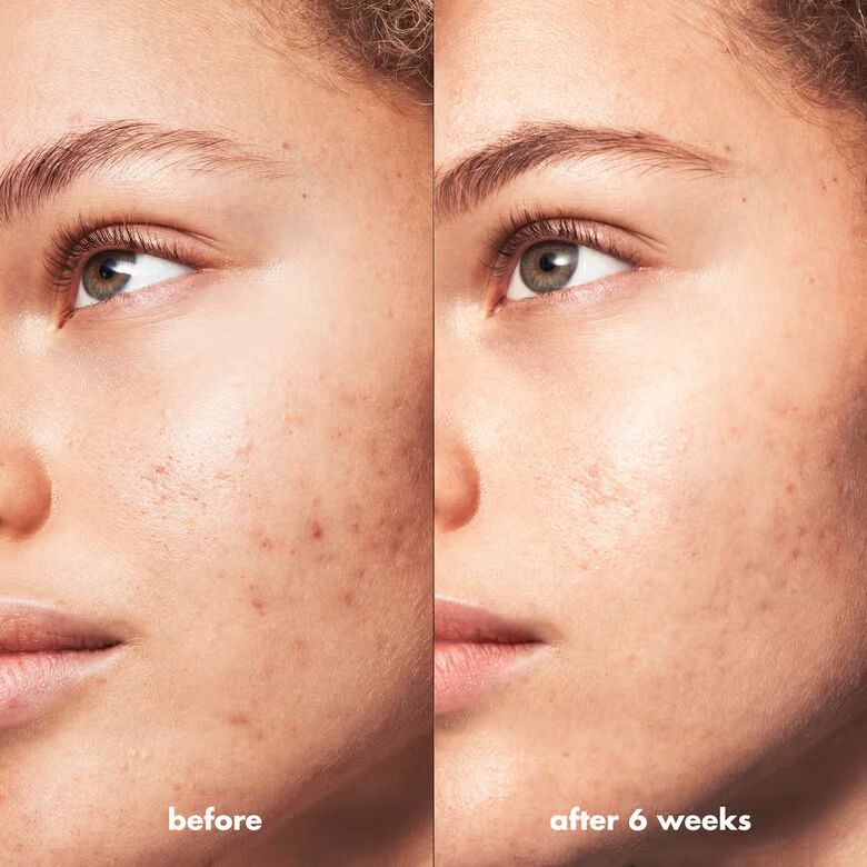 Blemish Breakthrough Acne Spot Gel_3