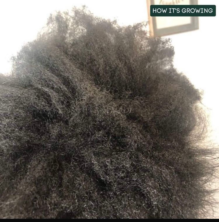 Hair growth and Antidandruff Combo_3