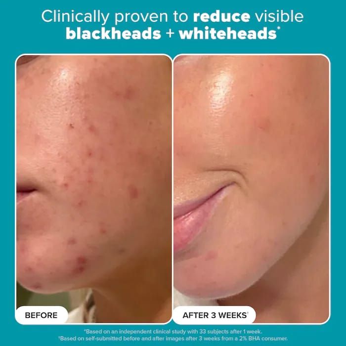 PAULA'S CHOICE - Skin Perfecting 2% BHA Exfoliating Toner for Clear Skin_2