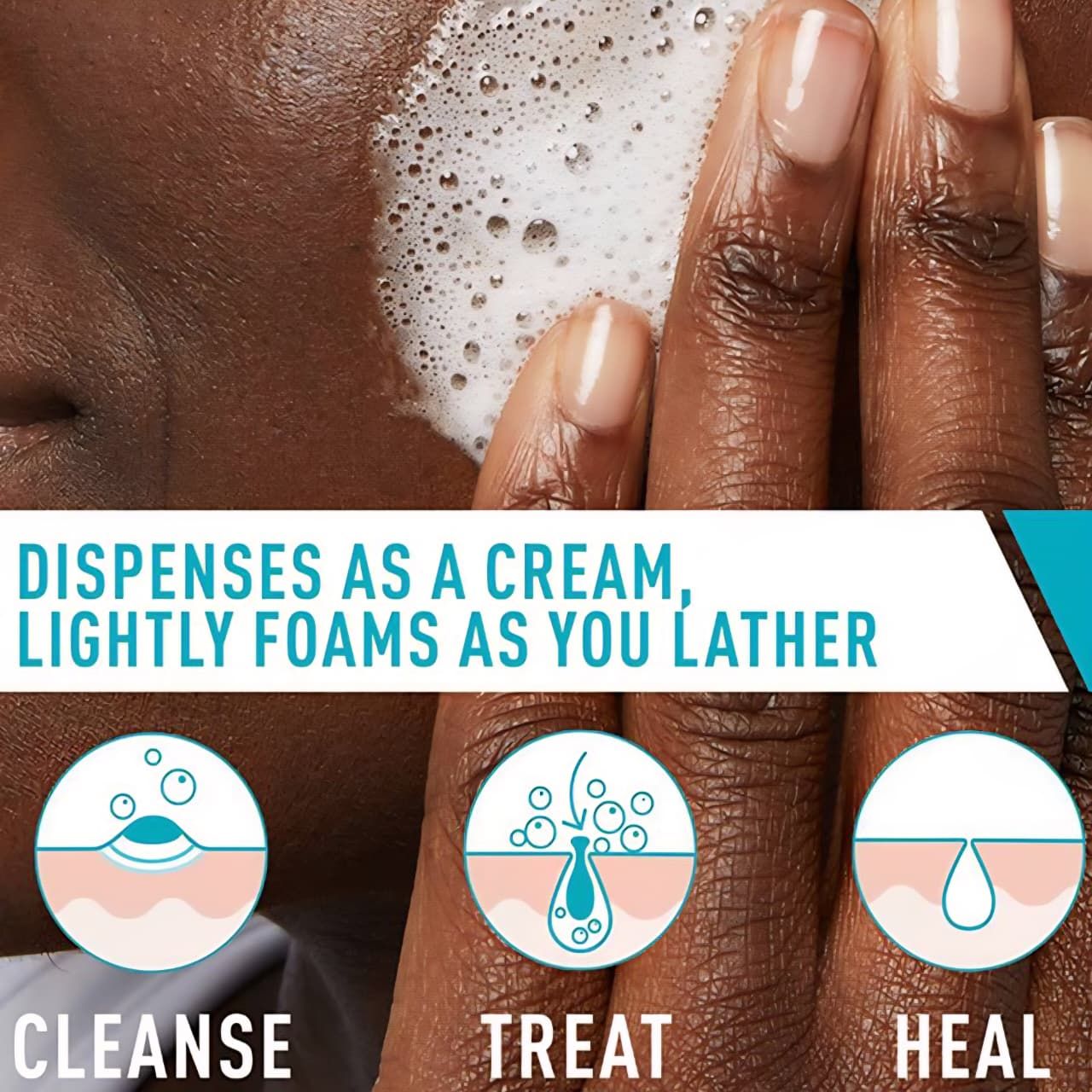 CeraVe - Acne Foaming Cream Cleanser, 4% Benzoyl Peroxide_2