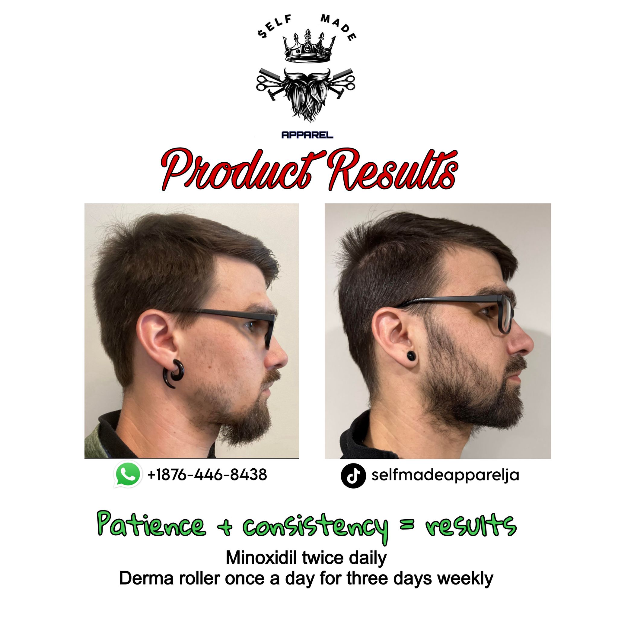 Minoxidil Foam Solution_2