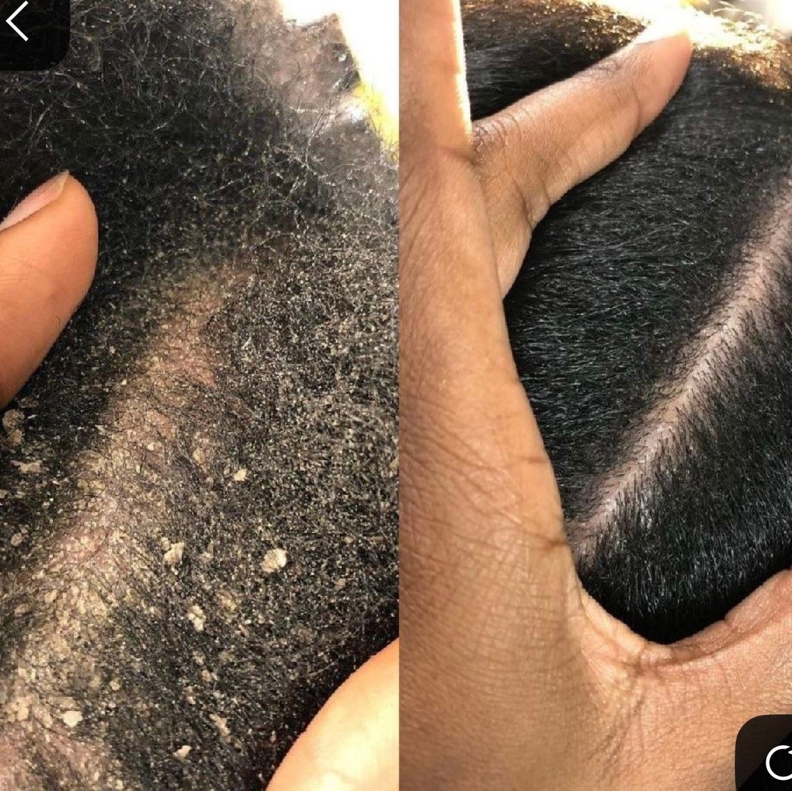 Nizoral Anti-Dandruff Shampoo 2% Ketoconazole_1