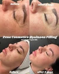 Zena Hyalnano Filling 2 vial set_3