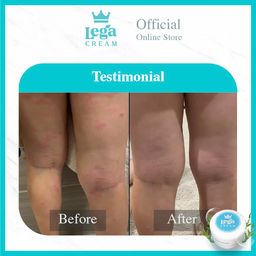 Lega Cream Eczema 5 gram