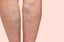 D-Dimer فحص تخثر الدم 