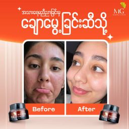 Mimosa Ginza_Melasma Cream (New)