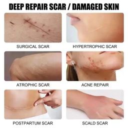 new arrival acne pimples stretch marks scar removal scar removal cream for old scars on face and legs body scar removal cream  
