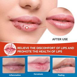 Sumifun Cheilitis Cream – Herbal Lip Care for Smooth & Healthy Lips