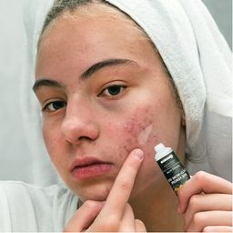 Bee Venom Anti-Acne Gel