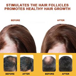 Bee Venom Alopecia Hair Growth Cream