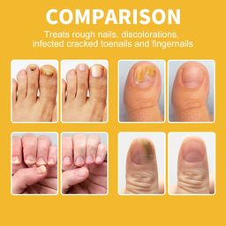 Sumifun NewBee Venom Fungal Nail Cream – Extra Strong Formula