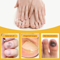 Sumifun NewBee Venom Fungal Nail Cream – Extra Strong Formula