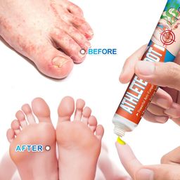Sumifun Athlete’s Foot Cream – Powerful Anti-Fungal Treatment, Relieves Itching & Odor, Soothes Cracked Skin (20g x 2)