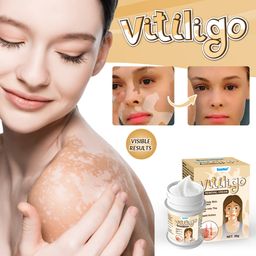Sumifun Vitiligo Removal Cream | Natural Pigment Regeneration Formula