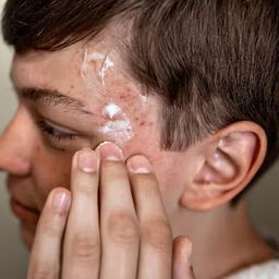 Sumifun Acne Care Cream with Tea Tree Oil