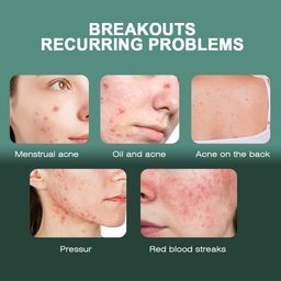 Sumifun Acne Care Cream with Tea Tree Oil