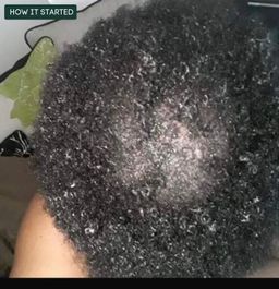 Hair growth and Antidandruff Combo