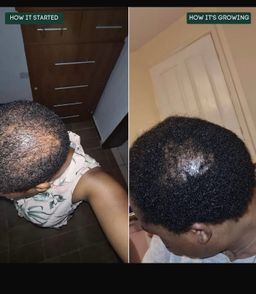 Hair growth and Antidandruff Combo