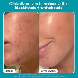 PAULA'S CHOICE - Skin Perfecting 2% BHA Exfoliating Toner for Clear Skin